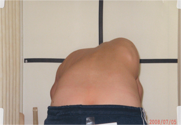 改善前前屈ボディ写真