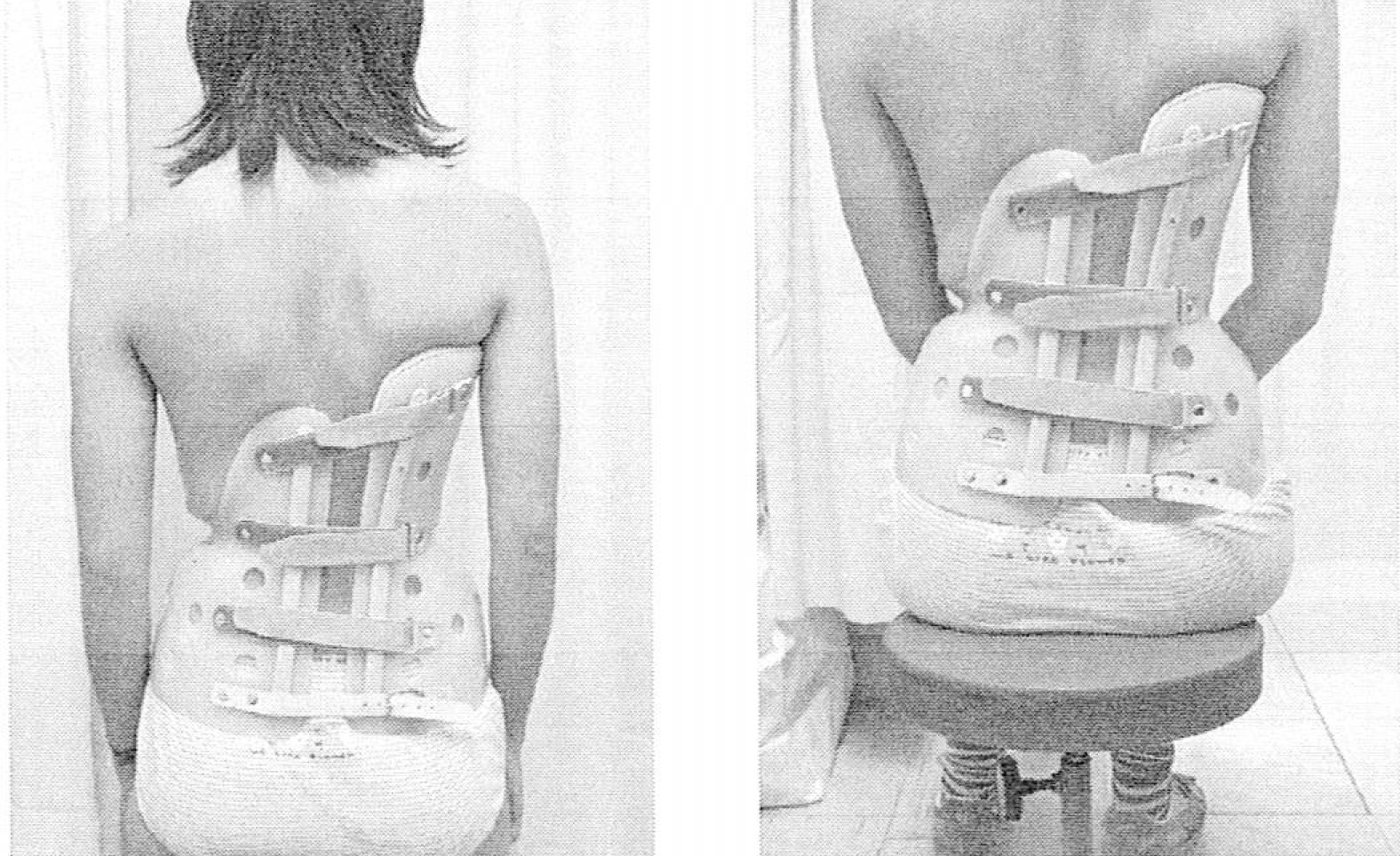 左肋骨弓突出例