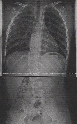 20170809改善前レントゲン