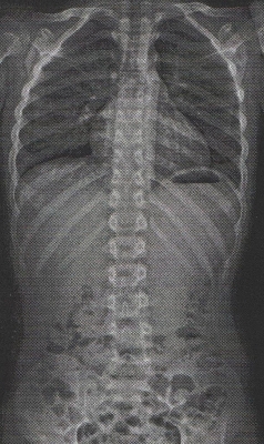 20170809改善後レントゲン