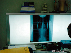 レントゲン平成22年2月17日