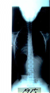 レントゲン写真