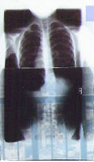 レントゲン写真Ａ